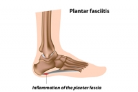 Plantar Fasciitis Symptoms and Risk Factors