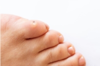 How to Identify and Treat a Foot Corn