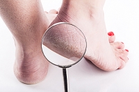 Medical Conditions Associated With Cracked Heels