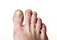 Prevention Methods for Toenail Fungus