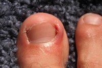 Causes and Symptoms of an Ingrown Toenail