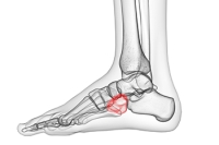 Cuboid Fractures and Cuboid Syndrome