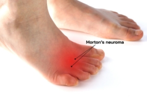 Challenges of Diagnosing Morton&#039;s Neuroma